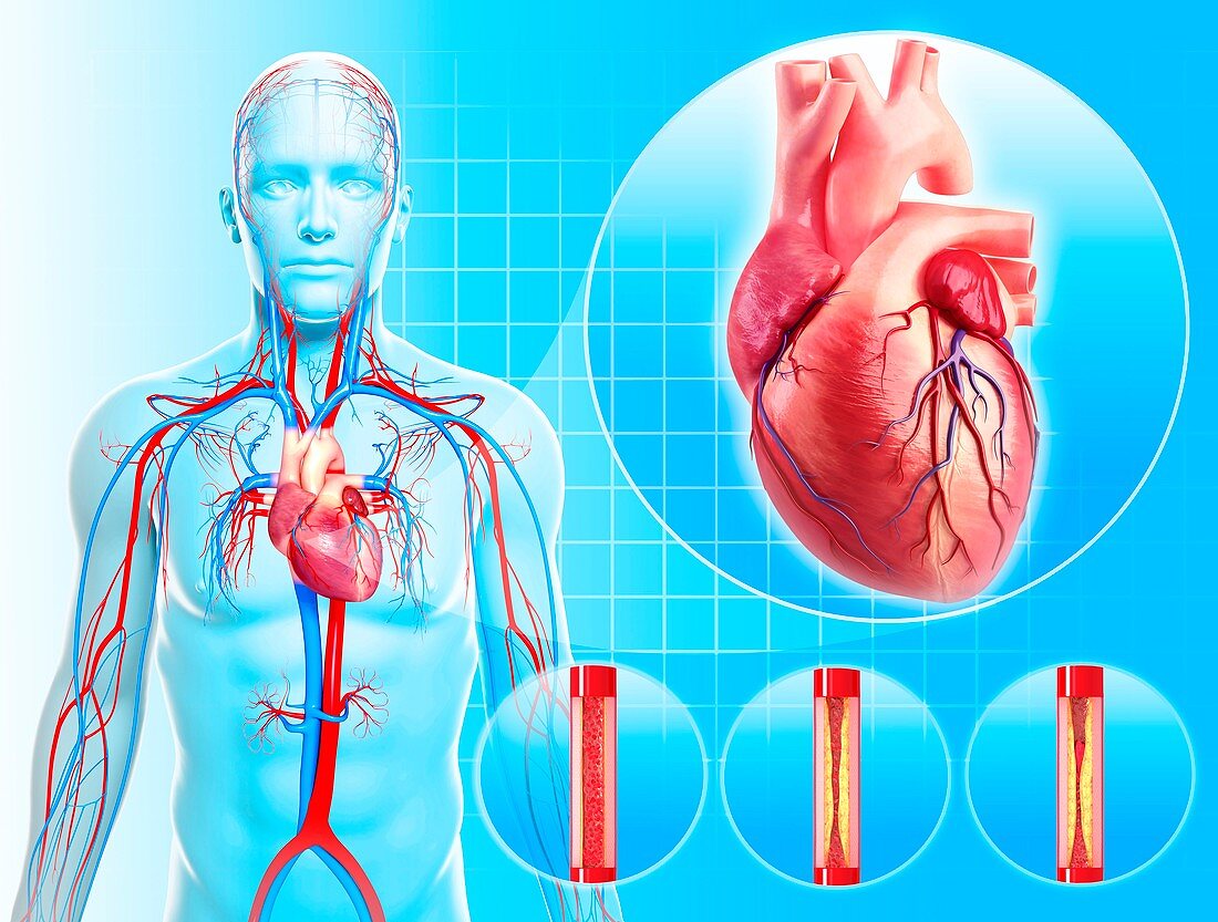 Atherosclerosis,artwork