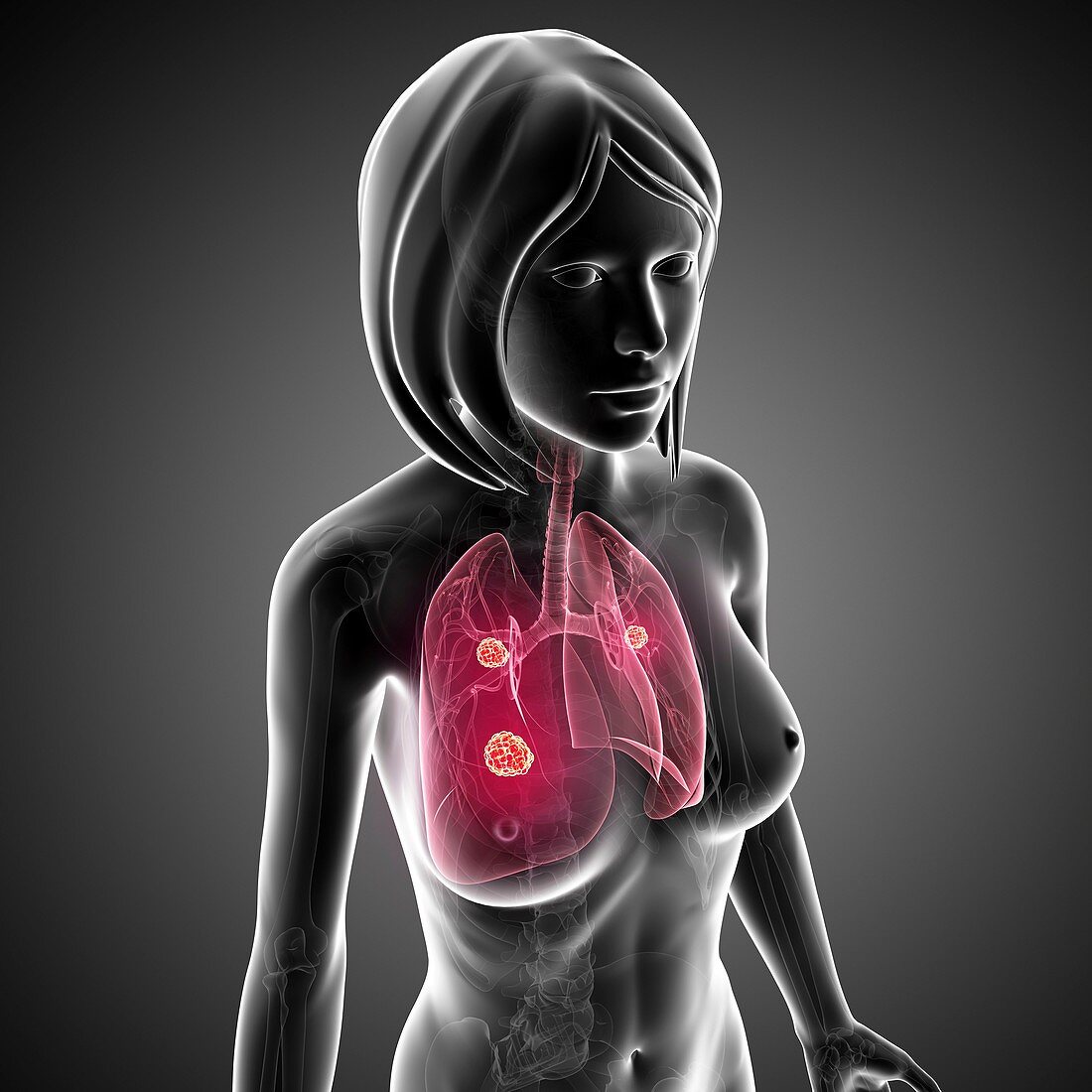 Female lung cancer,artwork