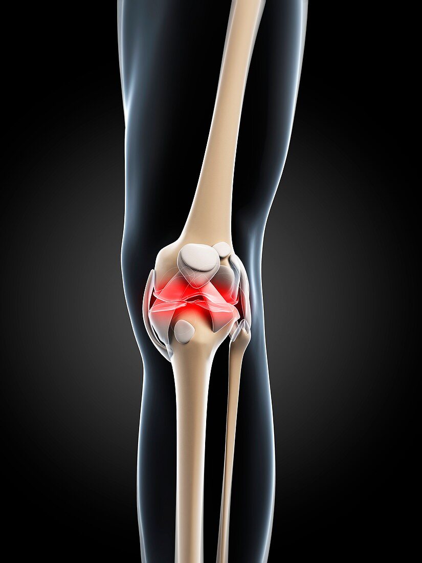 Knee pain,conceptual artwork