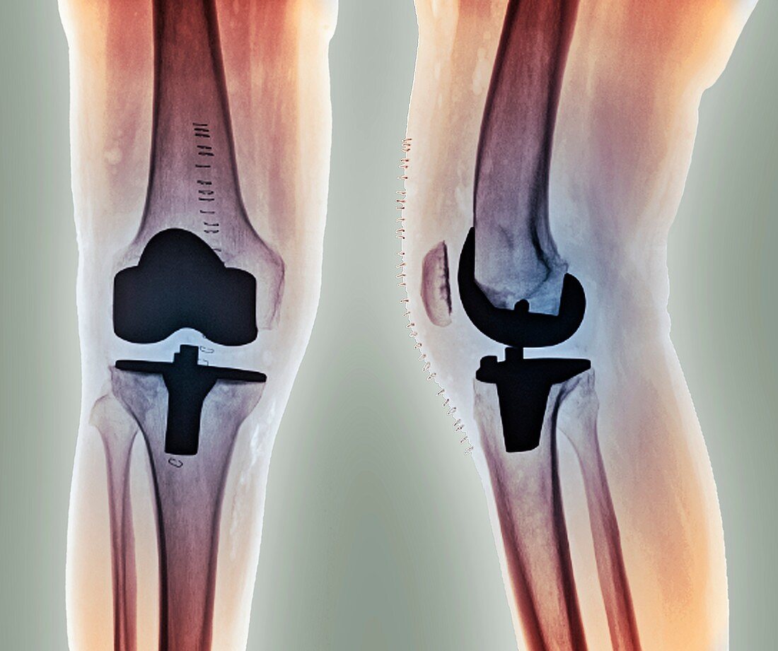 Total knee replacement,X-rays