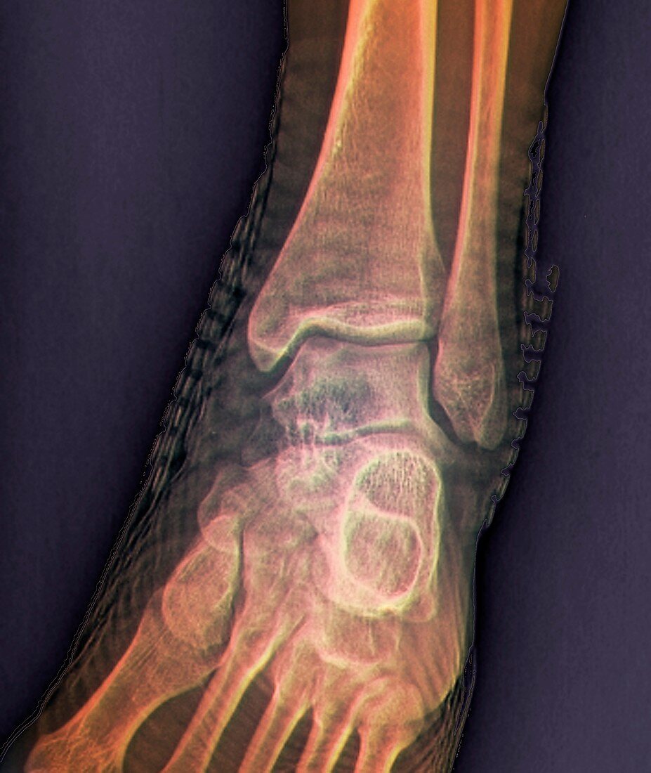 Healthy ankle joint,X-ray