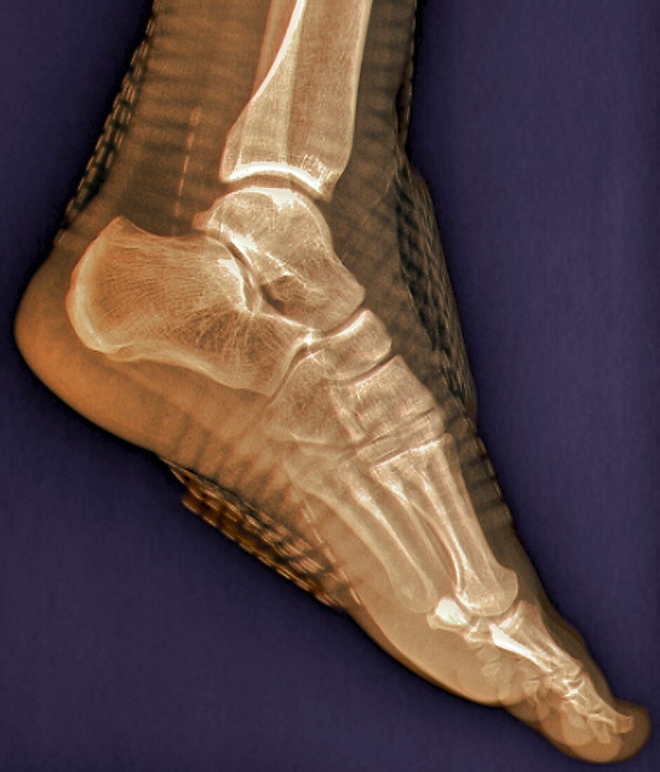 Healthy ankle joint,X-ray