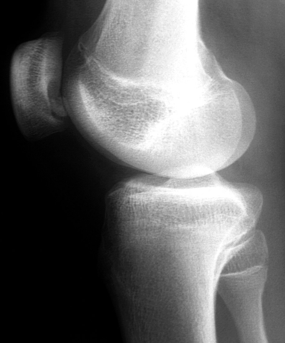Knee disease,X-ray