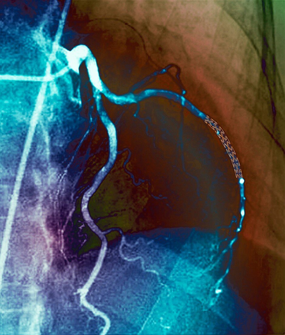 Coronary stent,X-ray