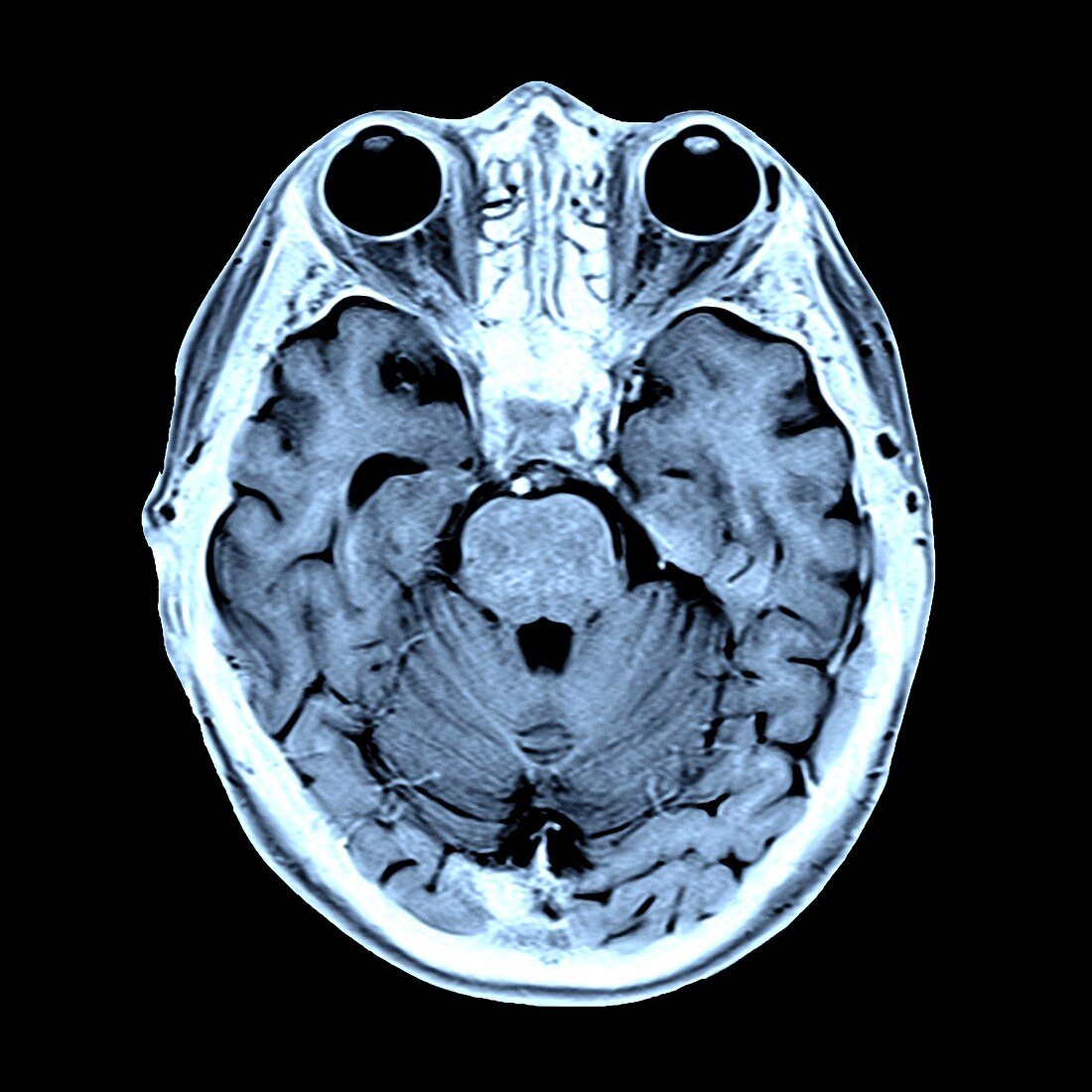 Coloured MRI scan of the human head