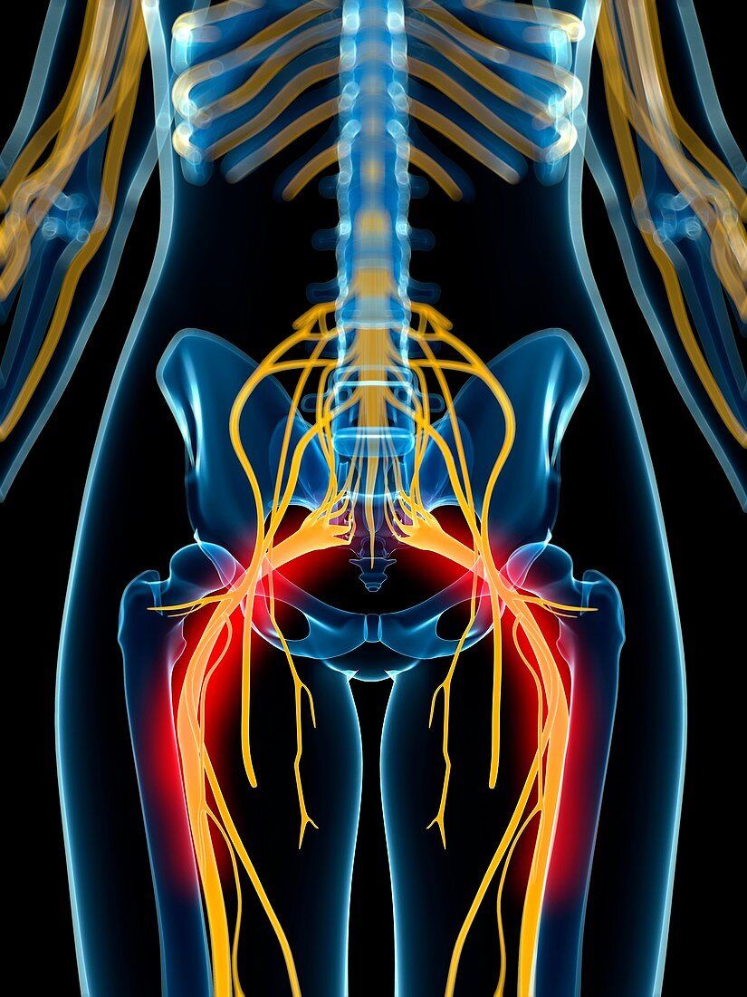 Painful sciatic nerve artwork