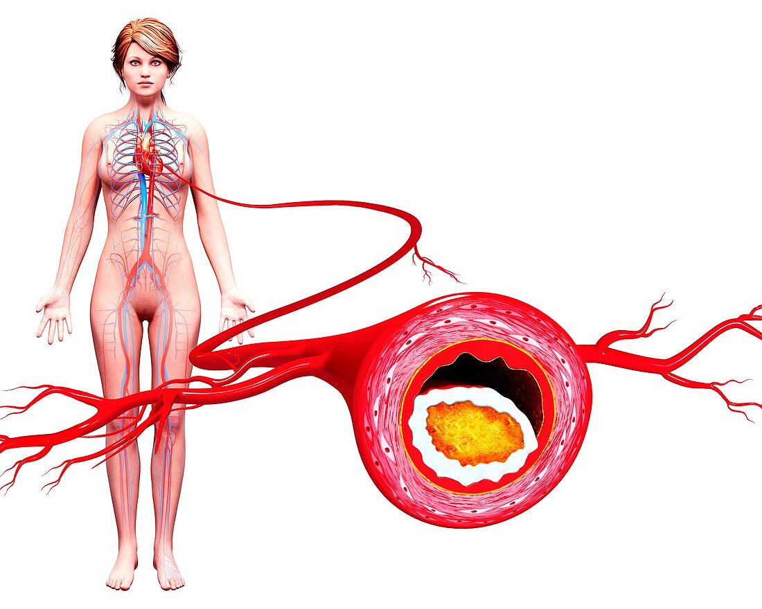 Atherosclerosis,artwork