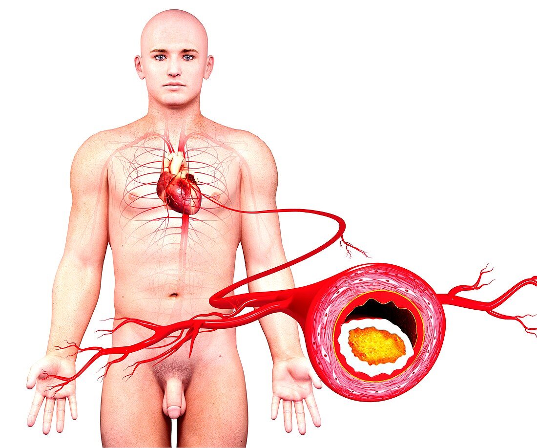 Atherosclerosis,artwork