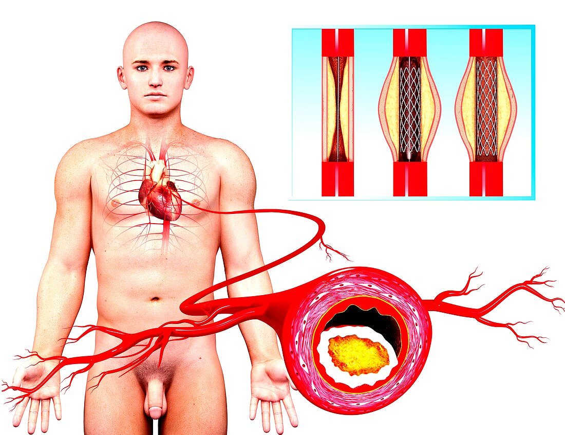 Angioplasty,artwork