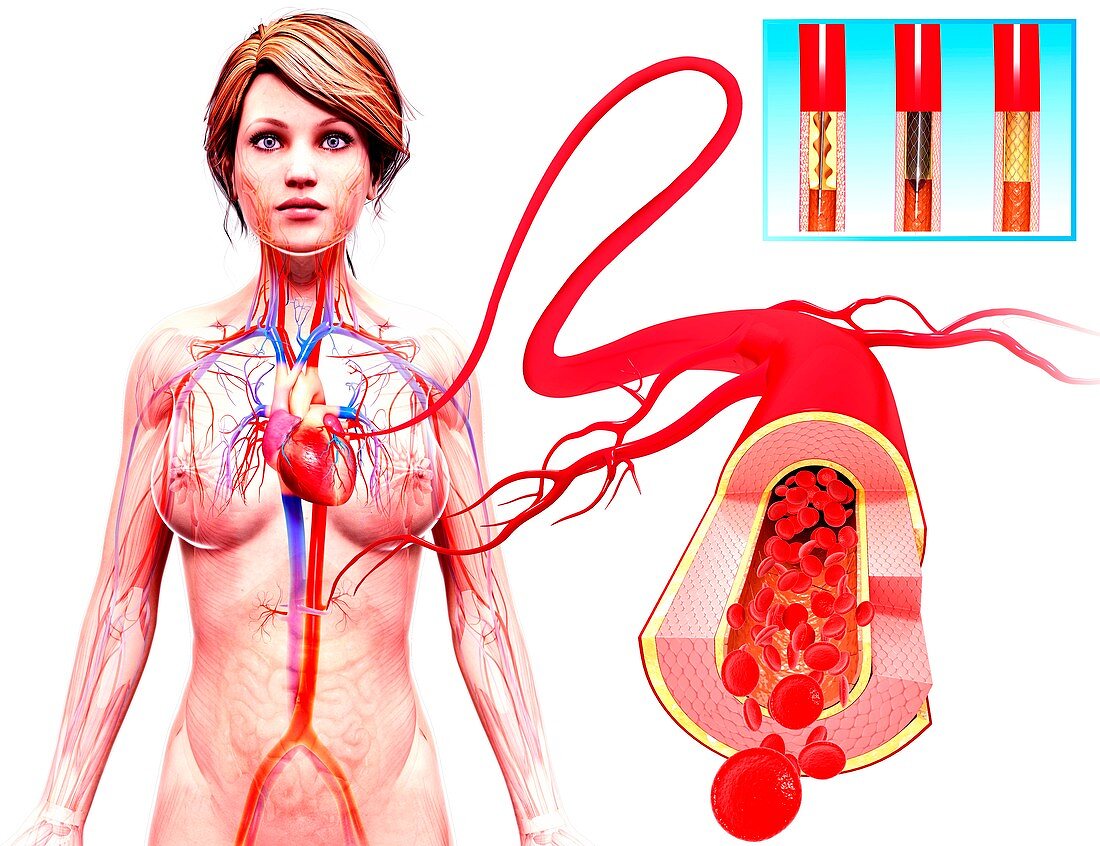 Angioplasty,artwork