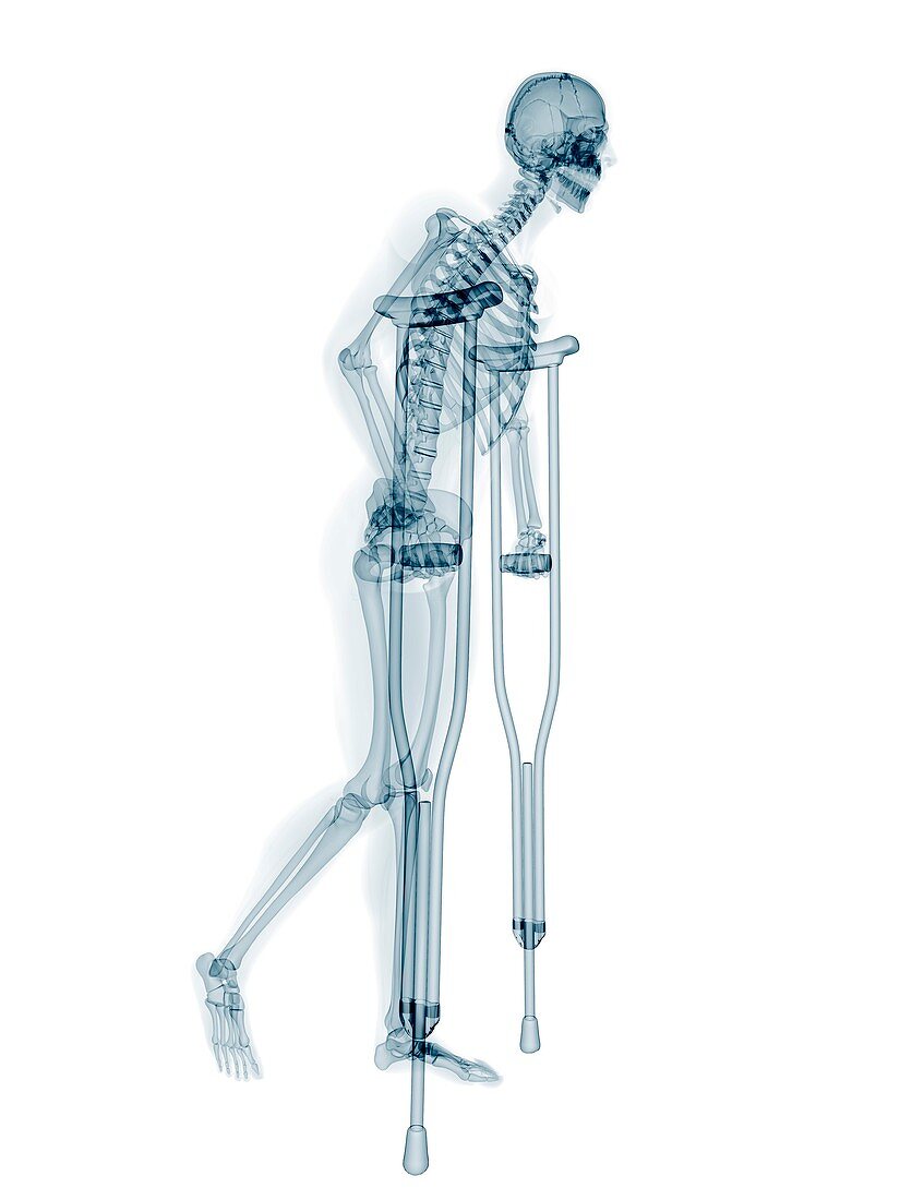 Skeleton on crutches,artwork