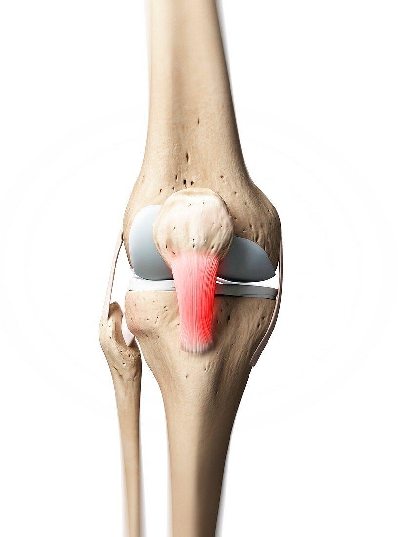 Inflamed patellar tendon,artwork