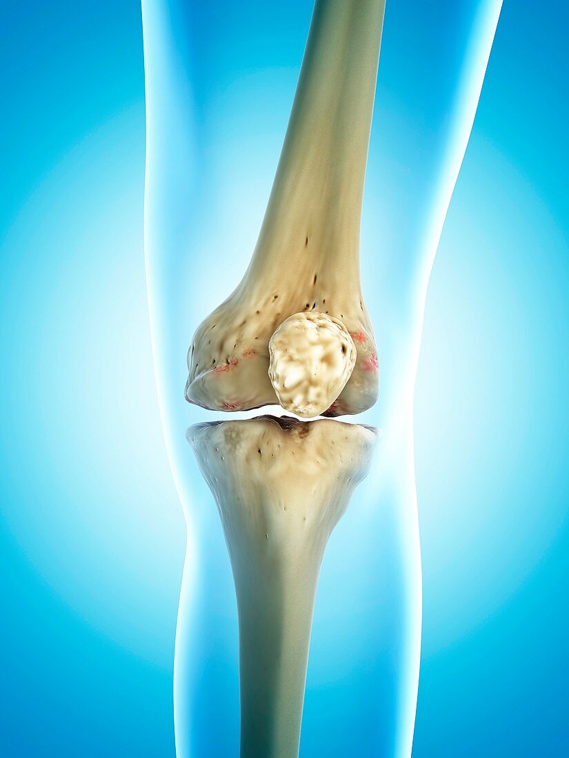 Arthritic knee,artwork