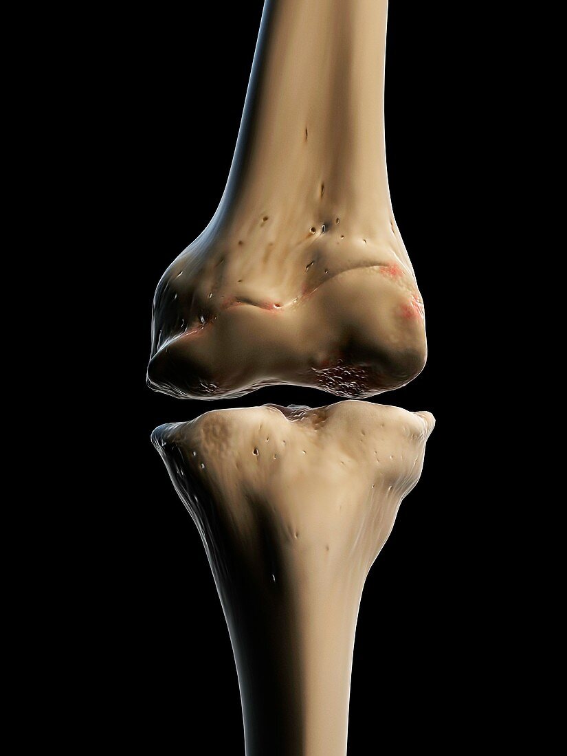 Arthritic knee,artwork