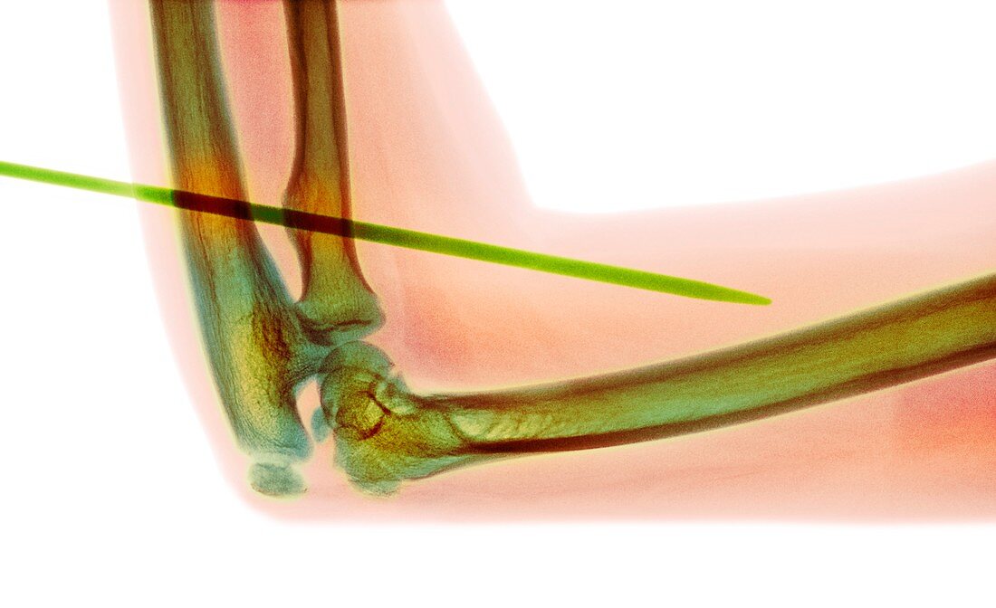 Knitting needle through arm,X-ray