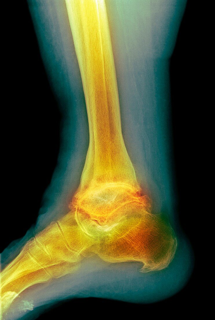 Osteoarthritis of the ankle,X-ray