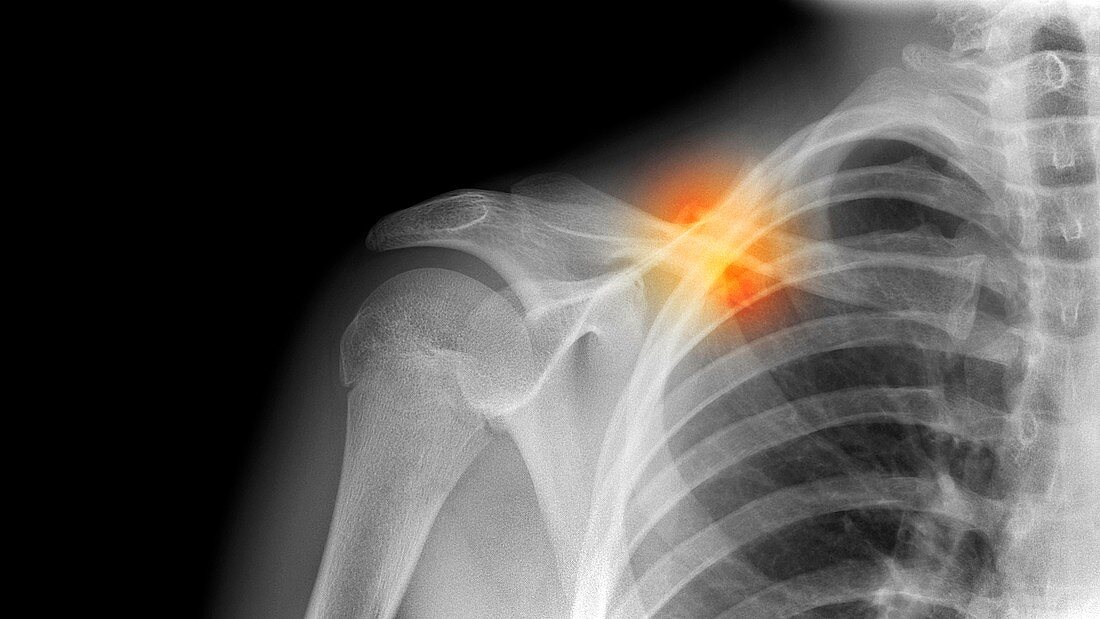 Fractured collarbone,X-ray