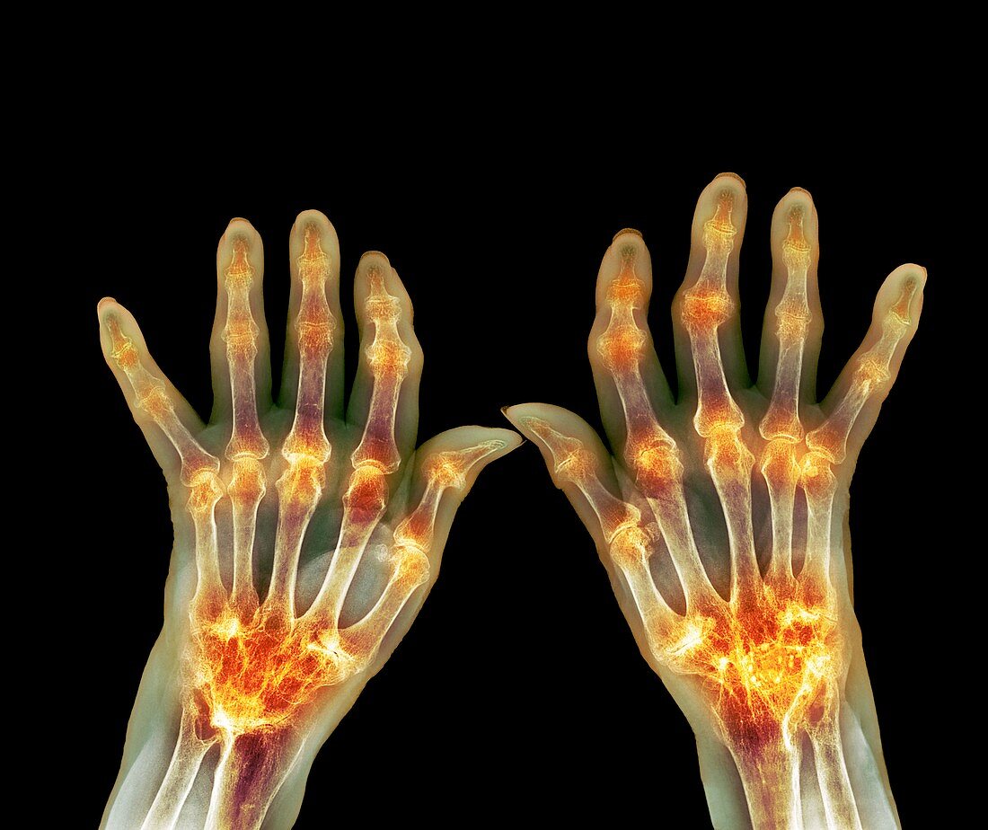 Rheumatoid arthritis,X-ray