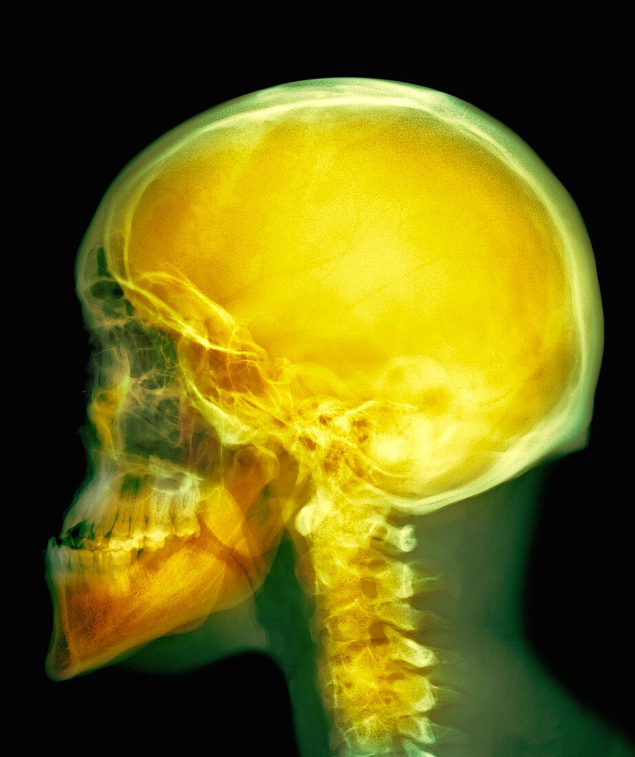 Skull,X-ray