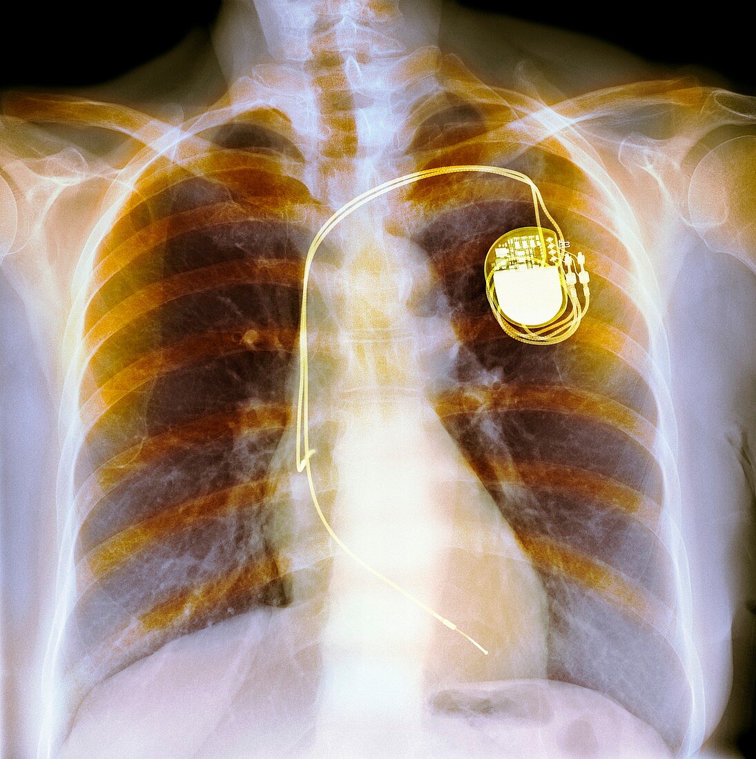 Dual chamber pacemaker,X-ray