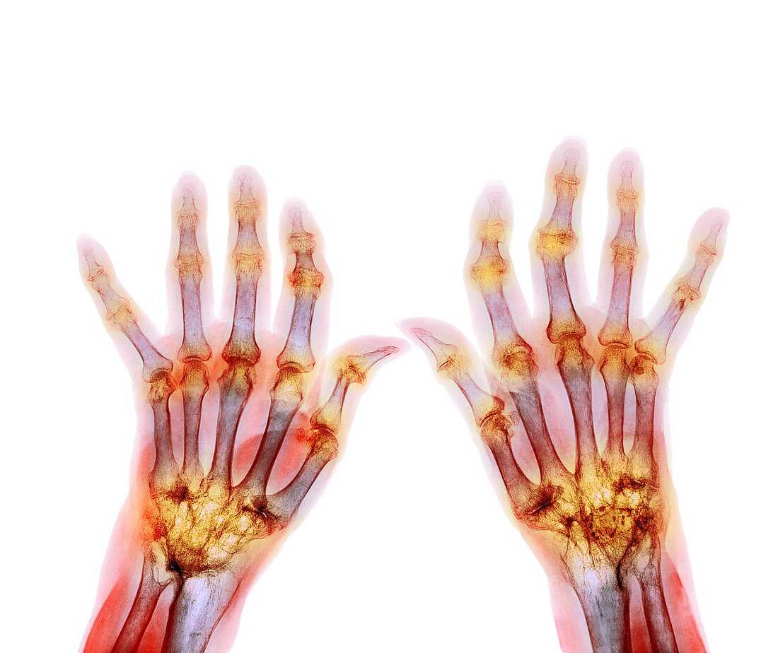 Rheumatoid arthritis,X-ray