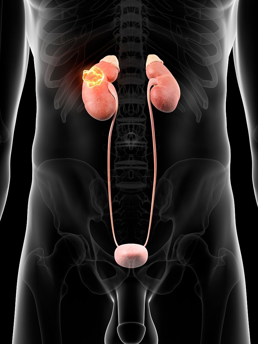 Human kidney with cancer,artwork