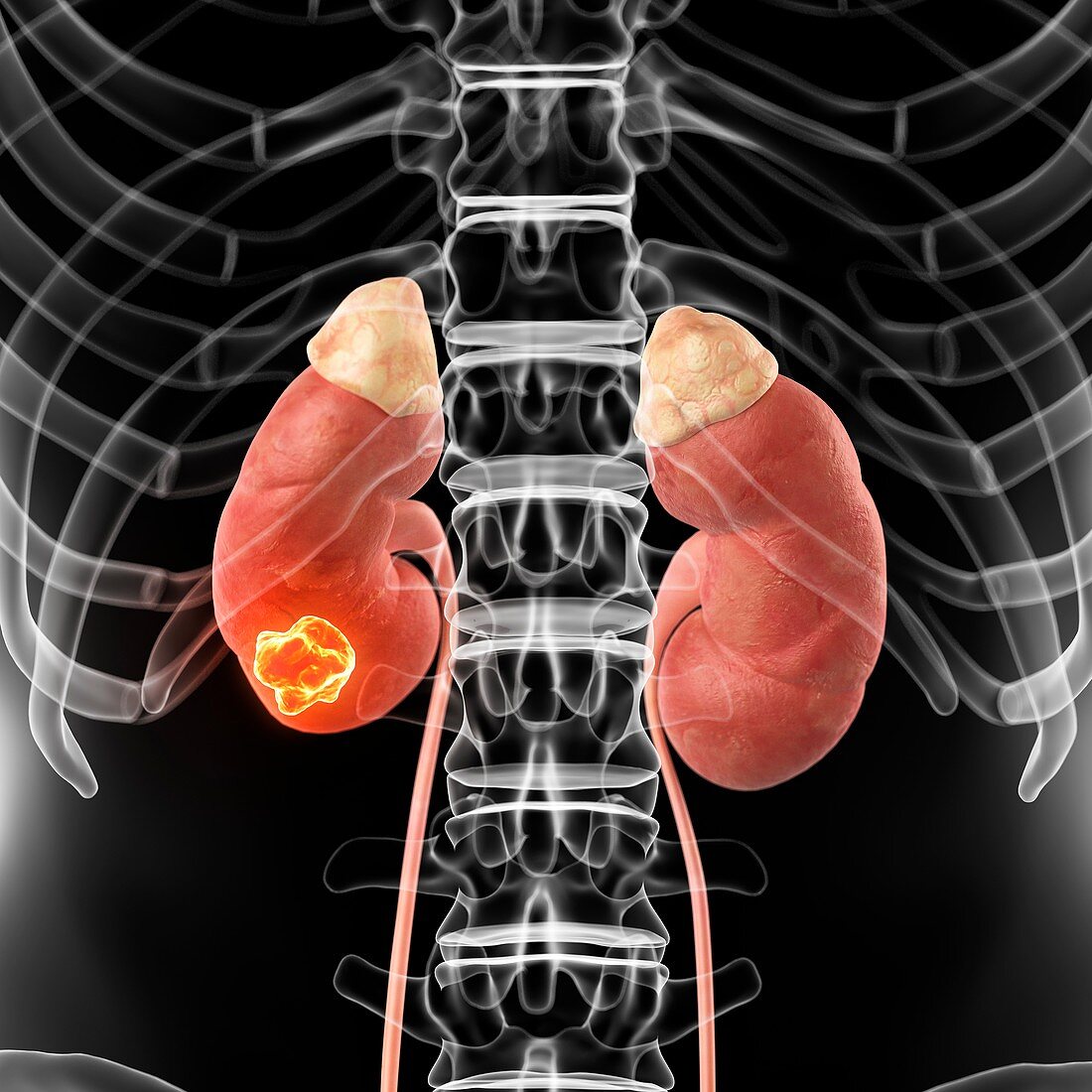 Human kidney with cancer,artwork