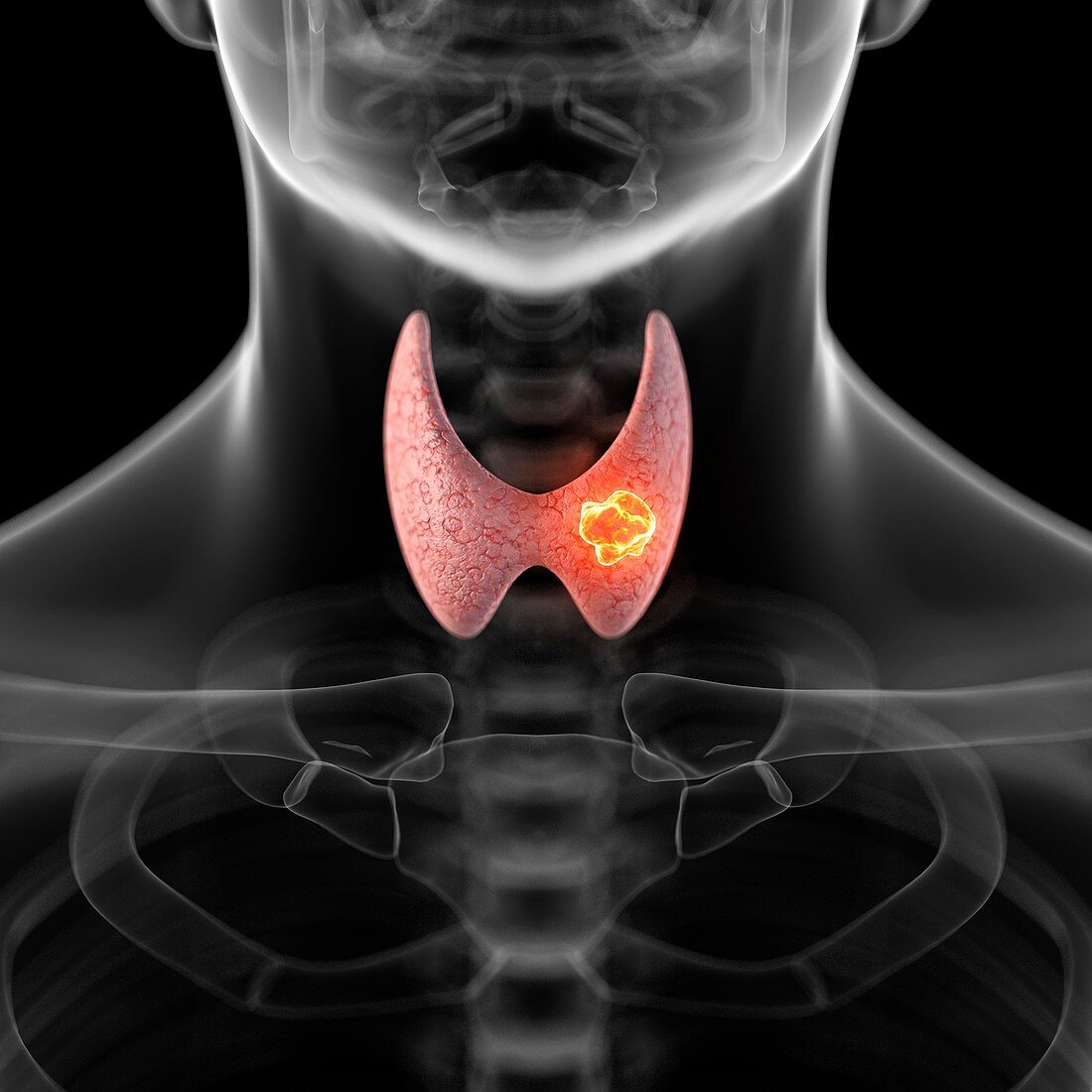 Tumor in human thyroid,artwork