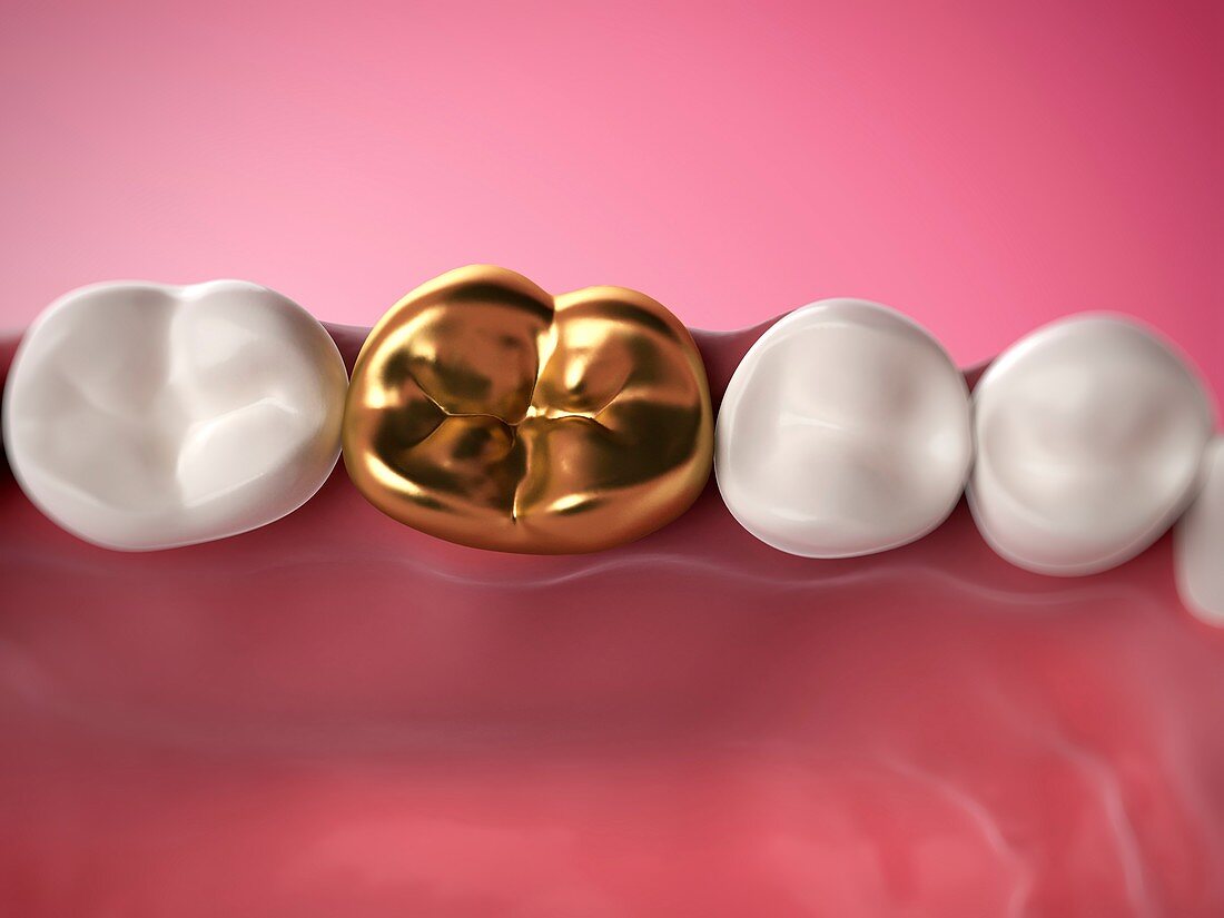 Gold filling in tooth,artwork