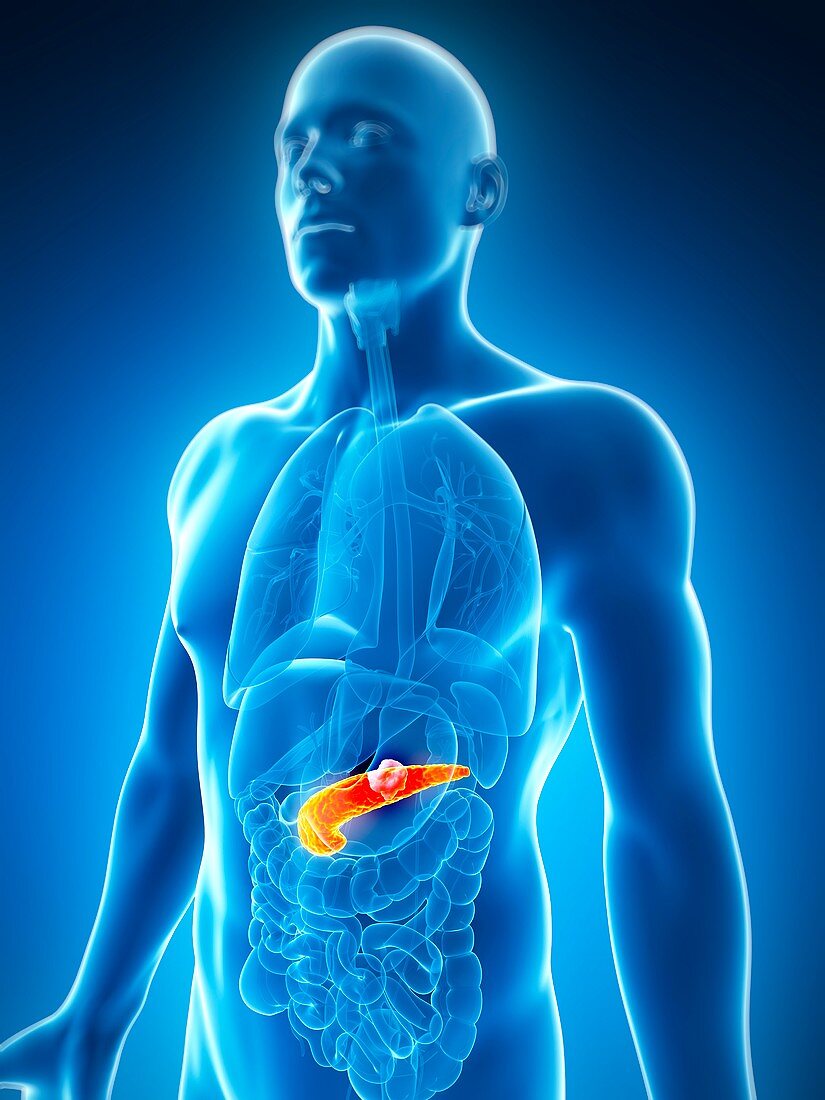 Human pancreas showing tumor,artwork