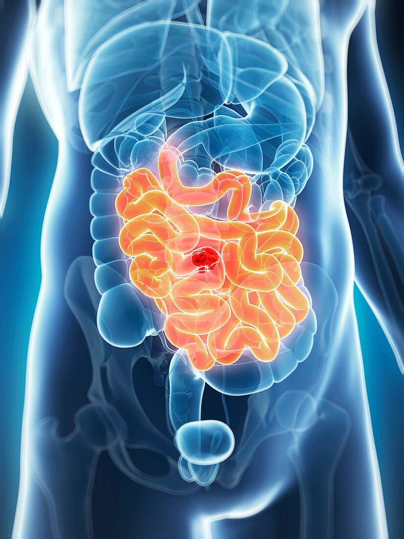 Human intestine tumor,illustration