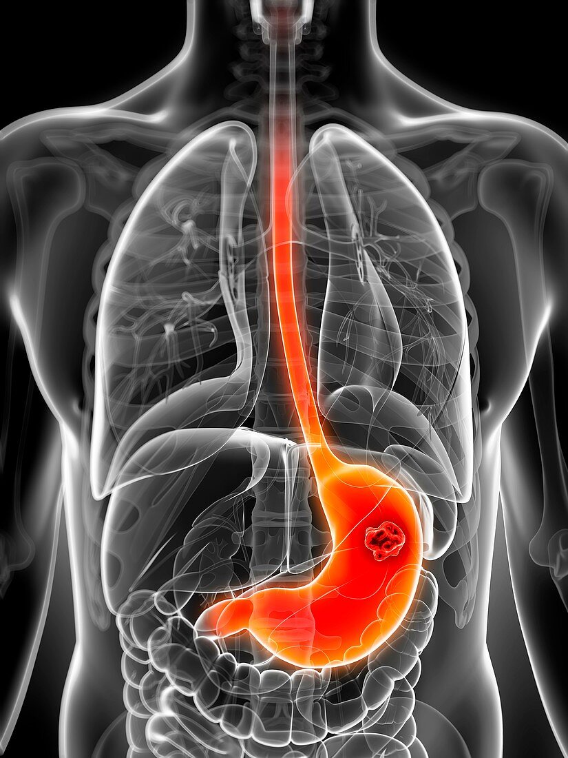 Human stomach cancer,illustration