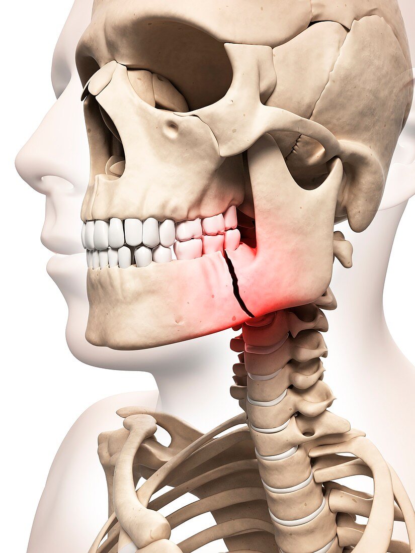 Broken jaw bone,illustration