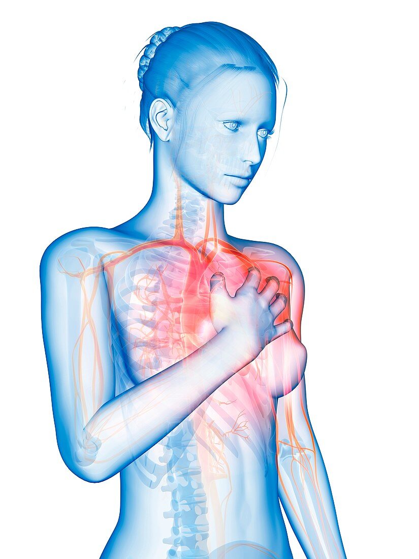 Human heart attack,illustration