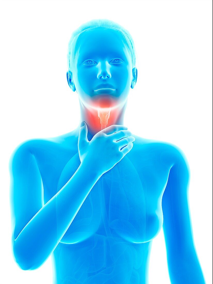 Inflammation of the larynx,illustration