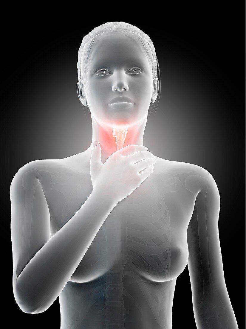 Inflammation of the larynx,illustration