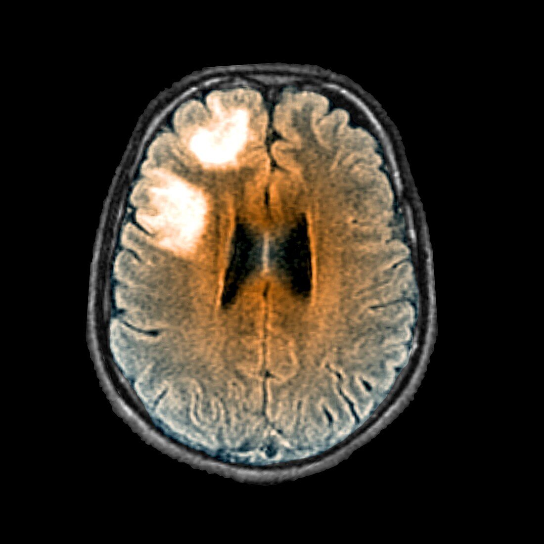 Leukoencephalopathy,MRI scan