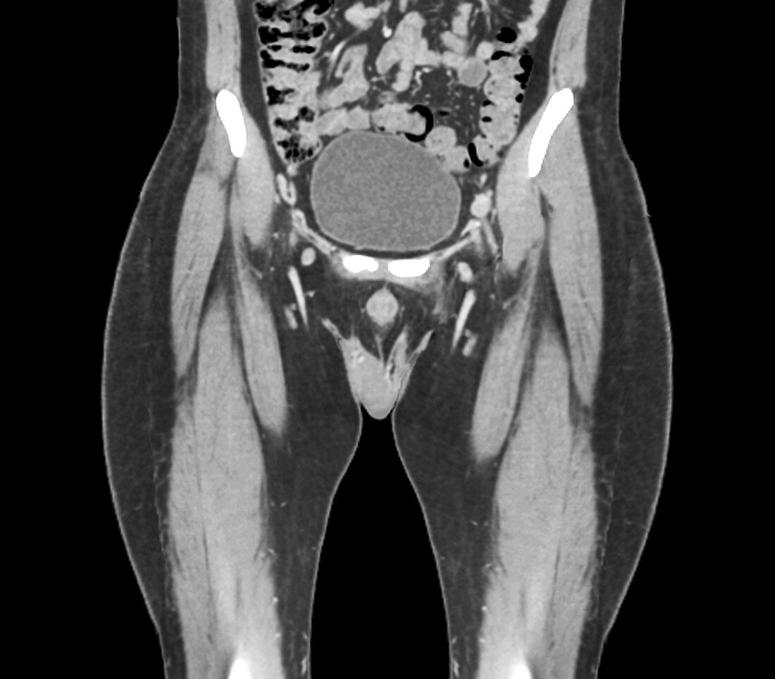 Healthy bladder,CT scan