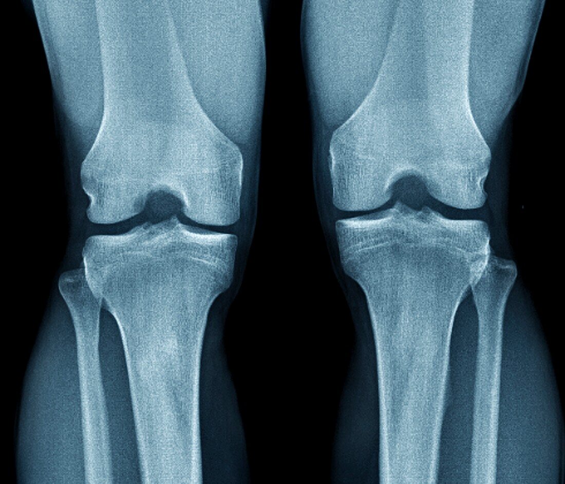 Normal knees,X-rays