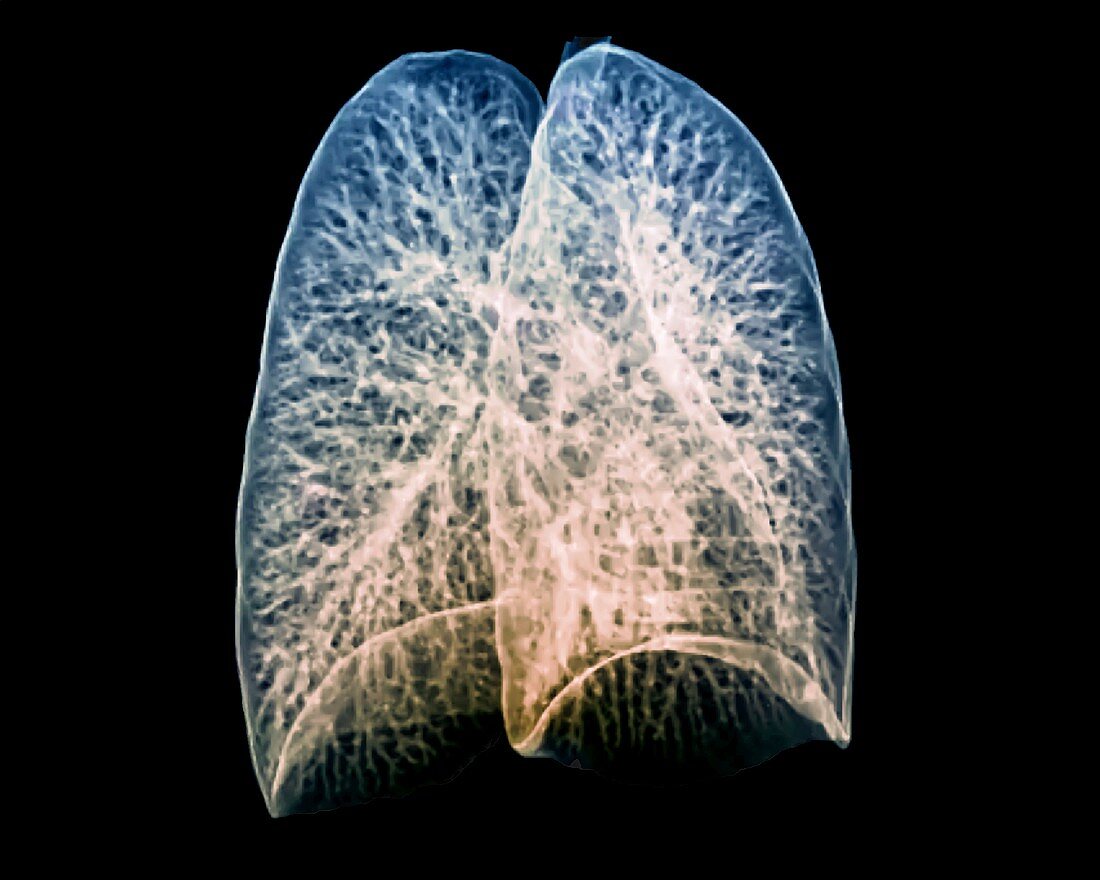 Healthy lungs,CT scan