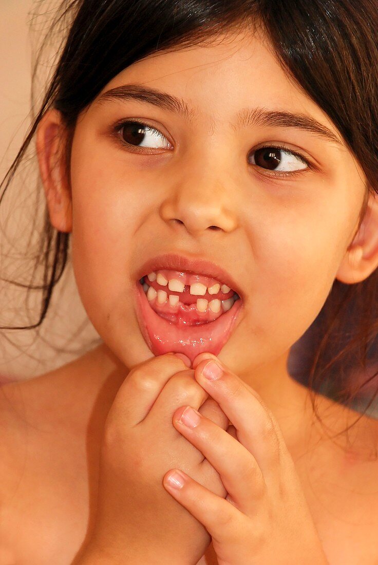 Girl with missing tooth