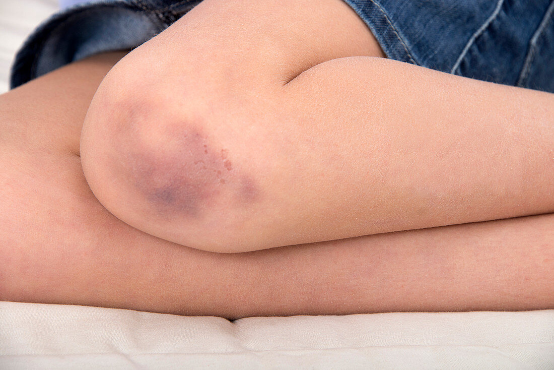 Girl with a bruised knee