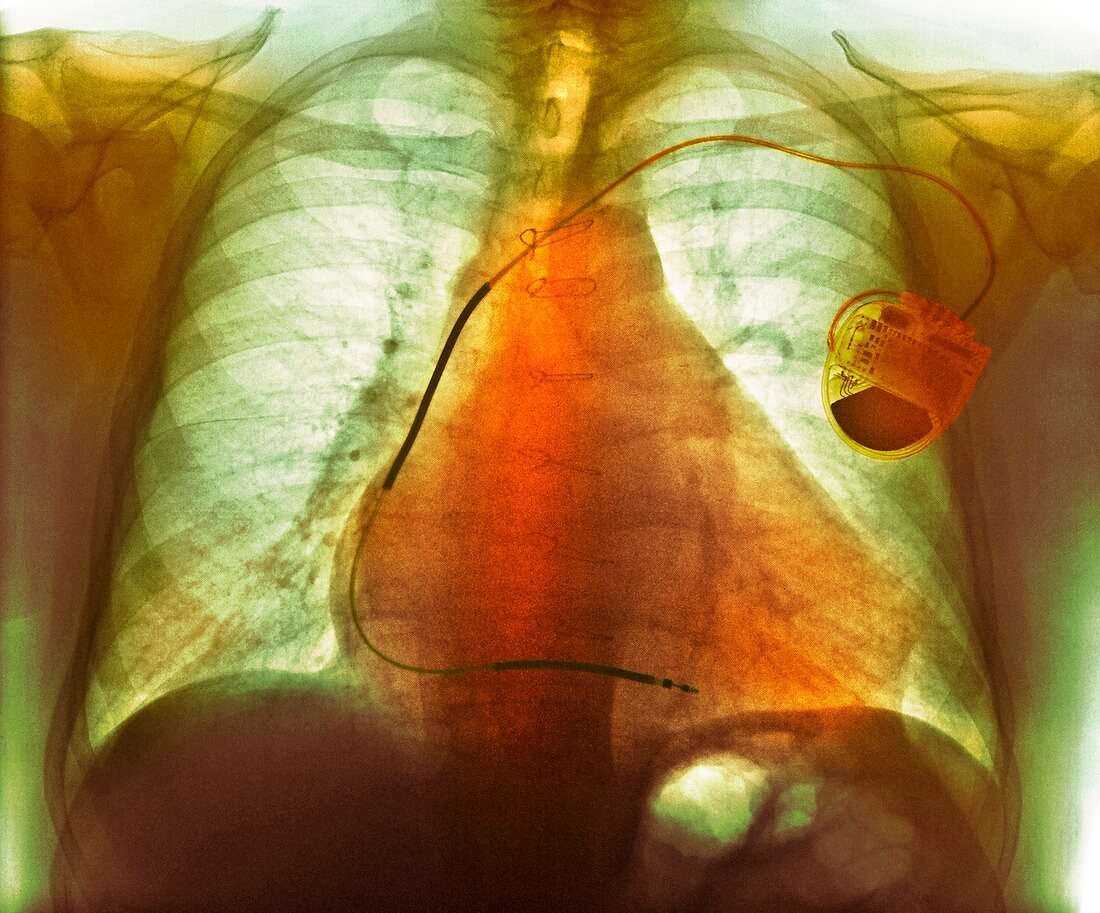 Pacemaker in heart disease,X-ray