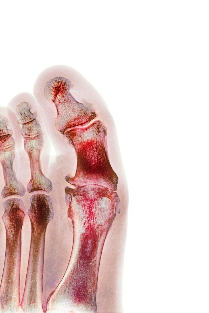 Degenerative foot deformation,X-ray