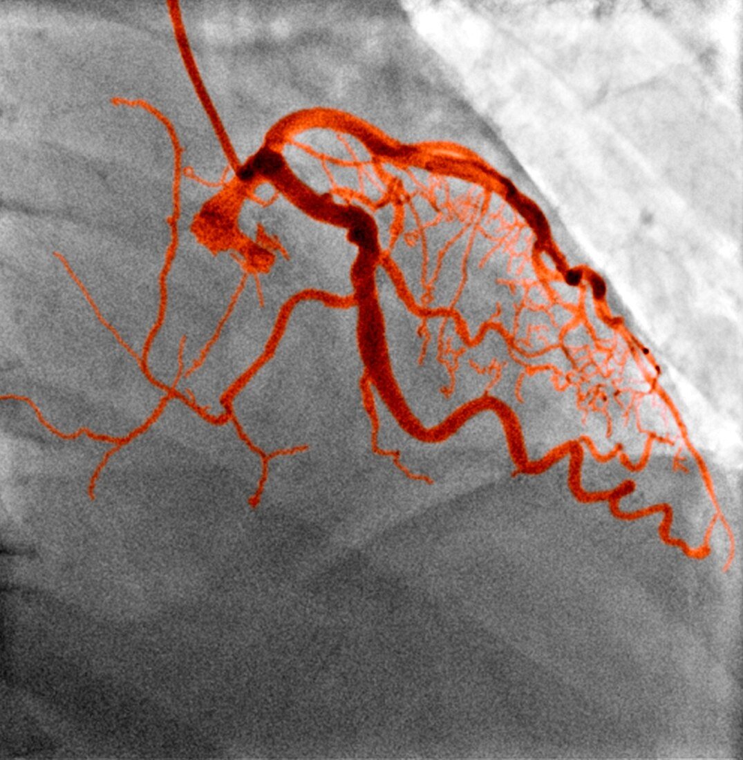 Normal blood vessels,X-ray