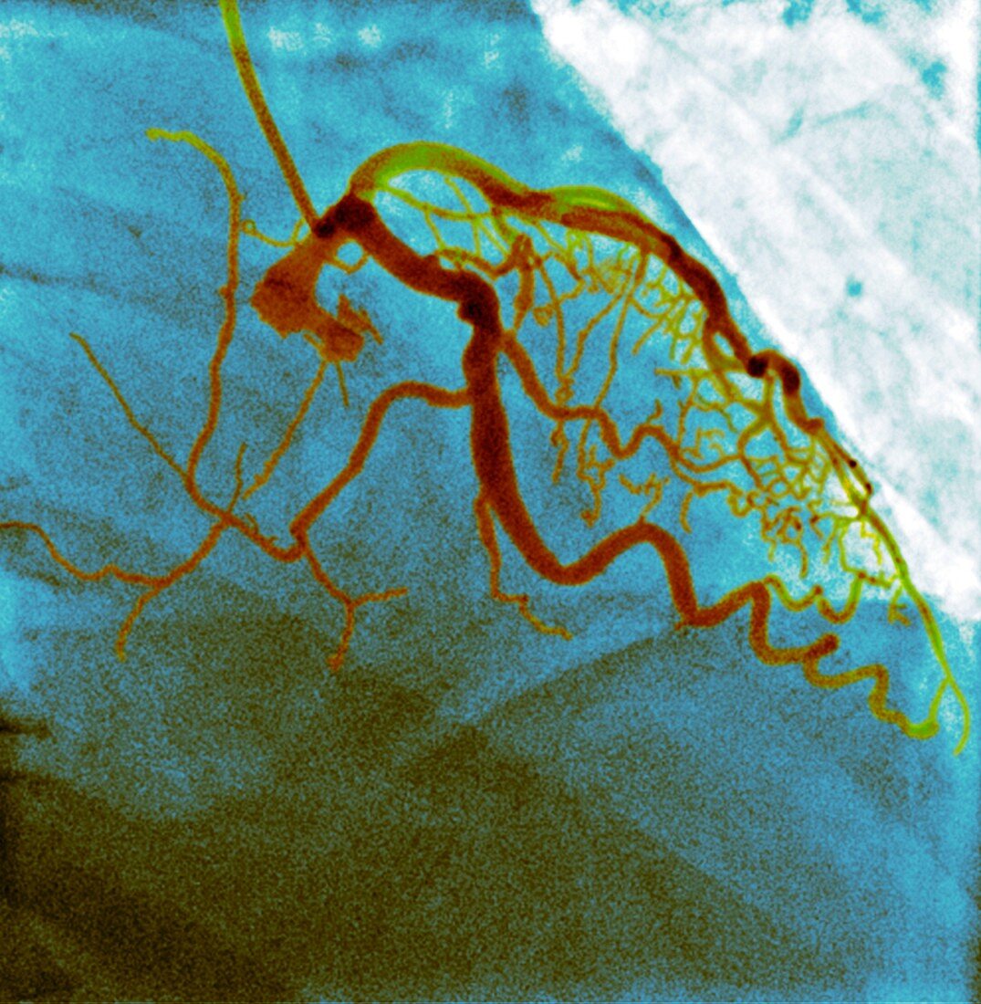 Normal blood vessels,X-ray