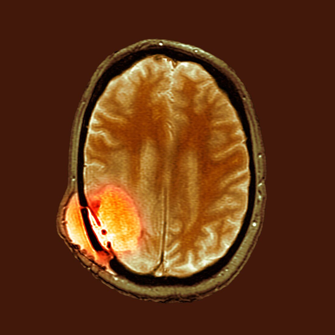 Brain cancer after surgery,MRI scan