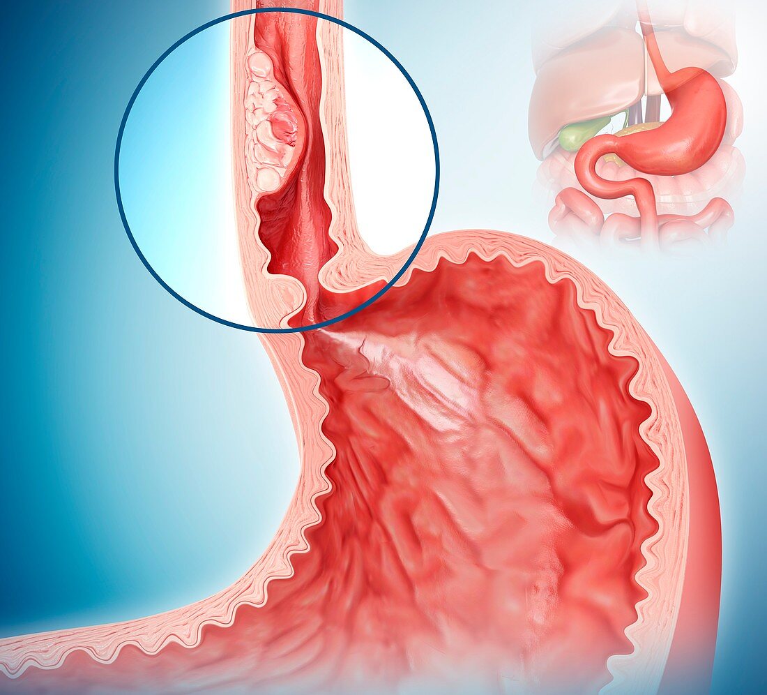 Oesophageal cancer,illustration