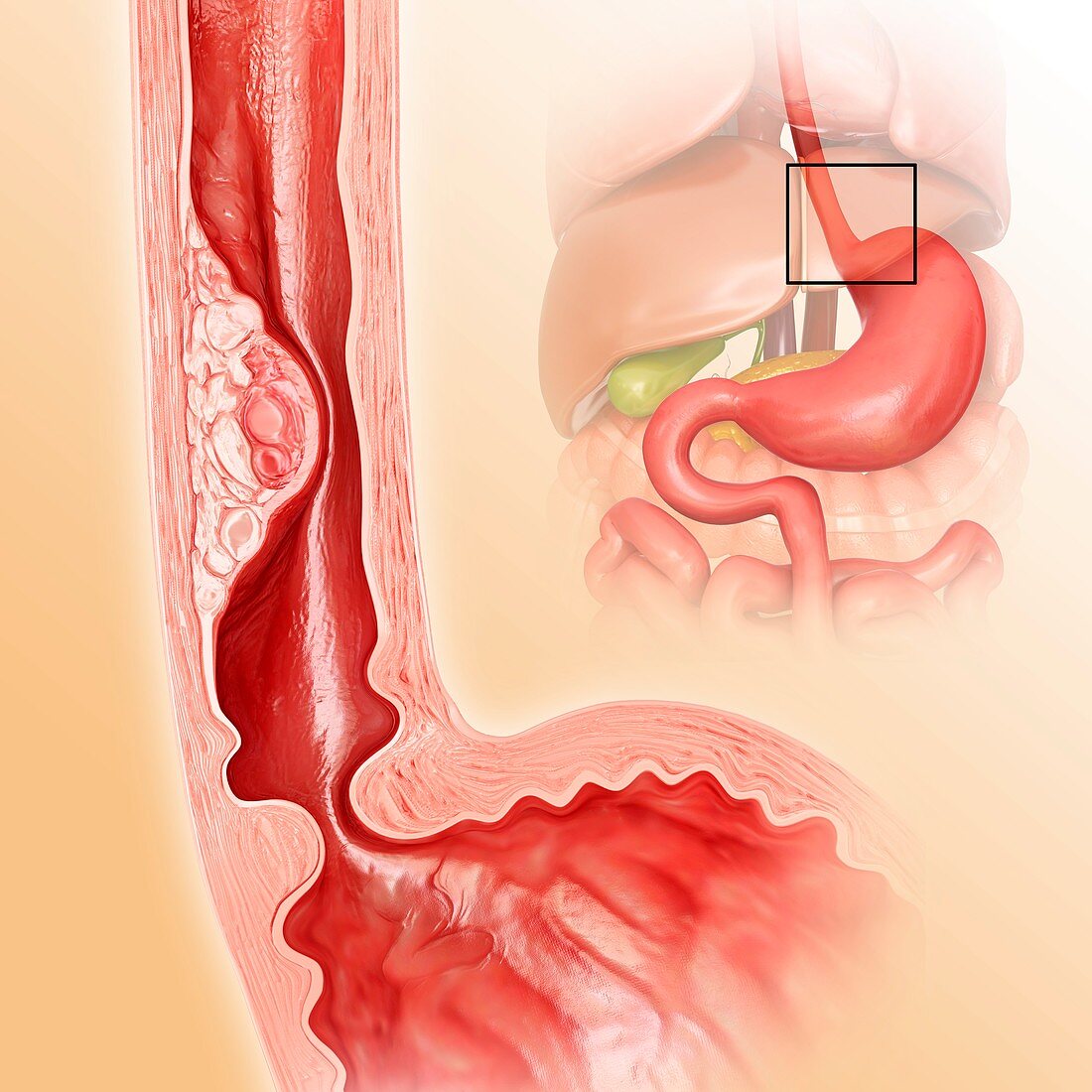 Oesophageal cancer,illustration