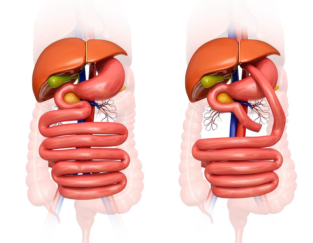 Gastric bypass,illustration